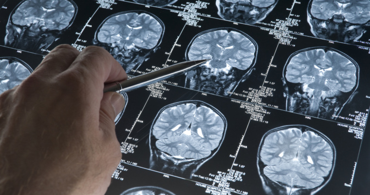 Studies Underway on 9/11 First Responder Brain Abnormalities Resembling Effects of Alzheimer’s Disease