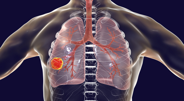 New Treatment Shrinks Lung Tumors Related to Ground Zero Exposure